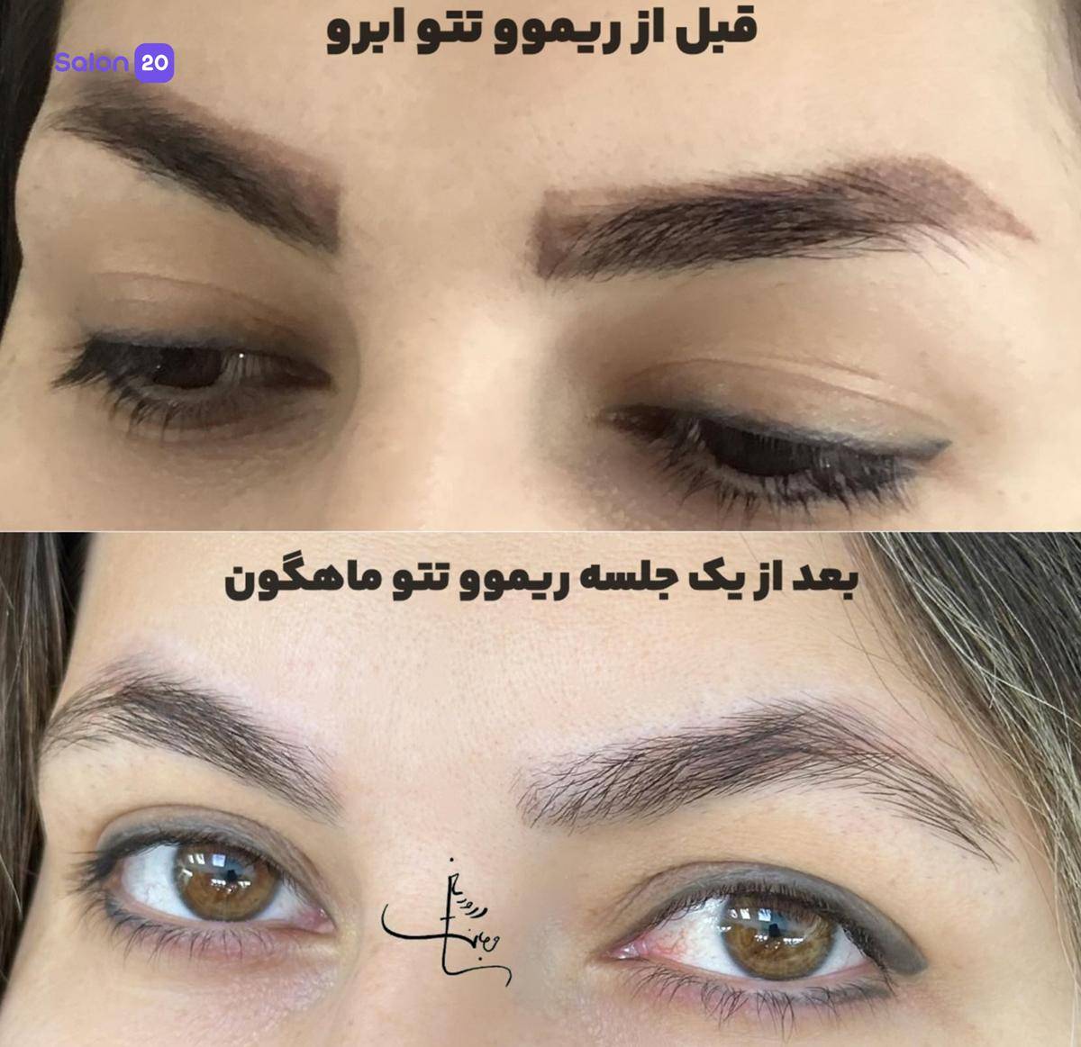 برترین لیفت ابرو قاسم آباد